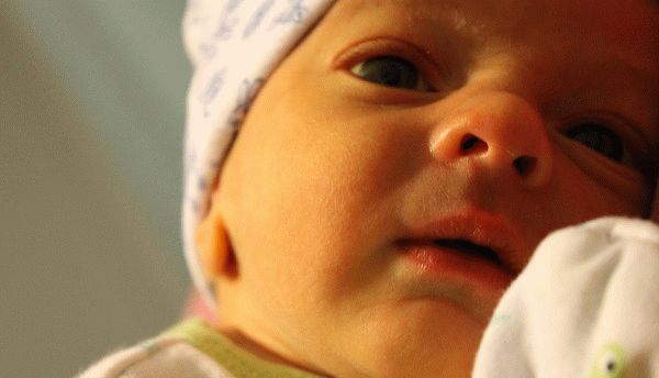 признаки желтушки у новорожденного фото