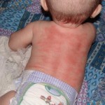 аллергическая крапивница у детей на коже фото
