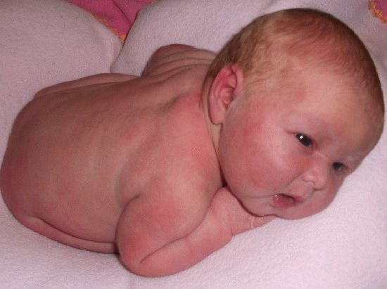 фото симптомов аллергия на яйца у ребенка