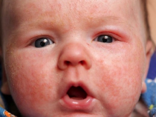 атопический дерматит на лице ребенка