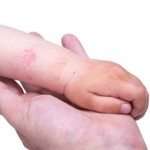 атопический дерматит на руке ребенка